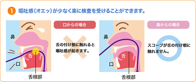 内視鏡を鼻から挿入する事により嘔吐感（オエッ）が少なく楽に検査を受けることができます。